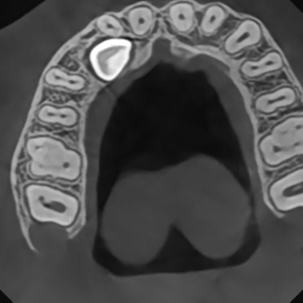 Coupe axiale CBCT