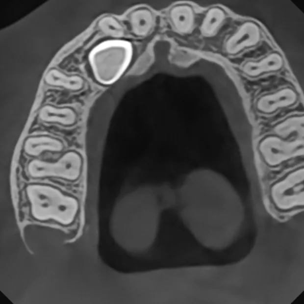 Coupe axiale CBCT