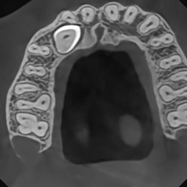 Coupe axiale CBCT