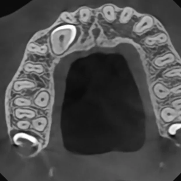 Coupe axiale CBCT